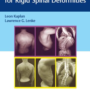 Corrective Osteotomies for Rigid Spinal Deformities (EPUB)