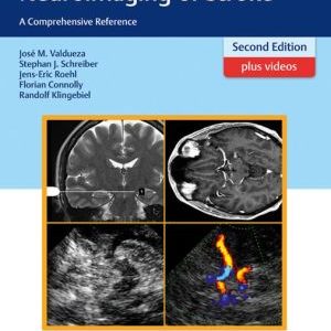 Neurosonology and Neuroimaging of Stroke: A Comprehensive Reference, 2nd Edition (PDF)