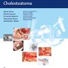 Microsurgical Management of Middle Ear and Petrous Bone Cholesteatoma (Original PDF from Publisher)