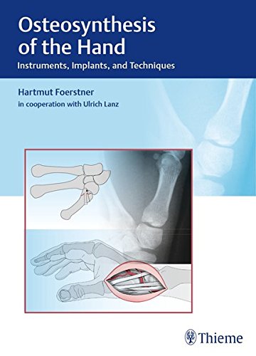 Osteosynthesis of the Hand: Instruments, Implants, and Techniques (EPUB)