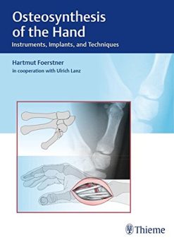 Osteosynthesis of the Hand: Instruments, Implants, and Techniques (PDF)