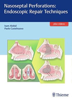 Nasoseptal Perforations: Endoscopic Repair Techniques (EPUB)
