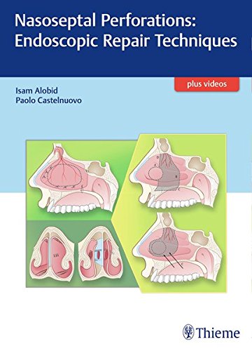 Nasoseptal Perforations: Endoscopic Repair Techniques (EPUB)