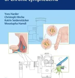 Modern Surgical Management of Chronic Lymphedema (Original PDF from Publisher)