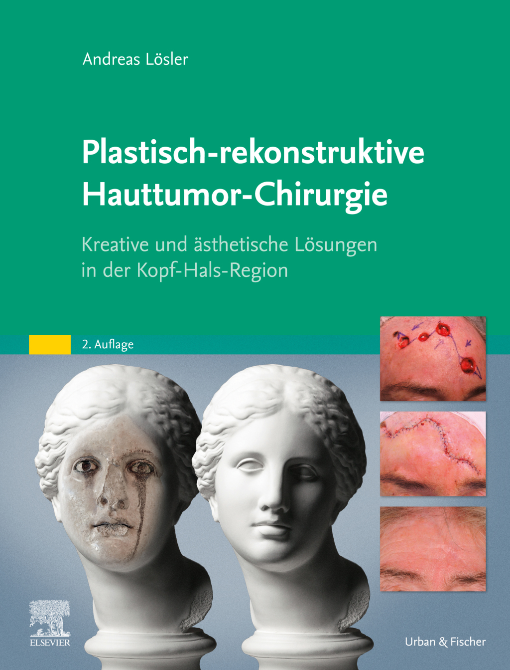 Plastisch-rekonstruktive Hauttumor-Chirurgie: Kreative und ästhetische Lösungen in der Kopf-Hals-Region, 2nd Edition (True PDF from Publisher)