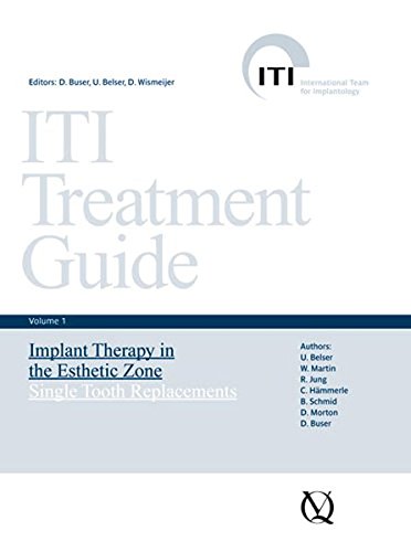 ITI Treatment Guide, Volume 1: Implant Therapy in the Esthetic Zone for Single-tooth Replacements (EPUB)