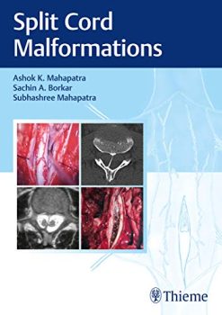 Split Cord Malformations, 2nd edition (Original PDF from Publisher)