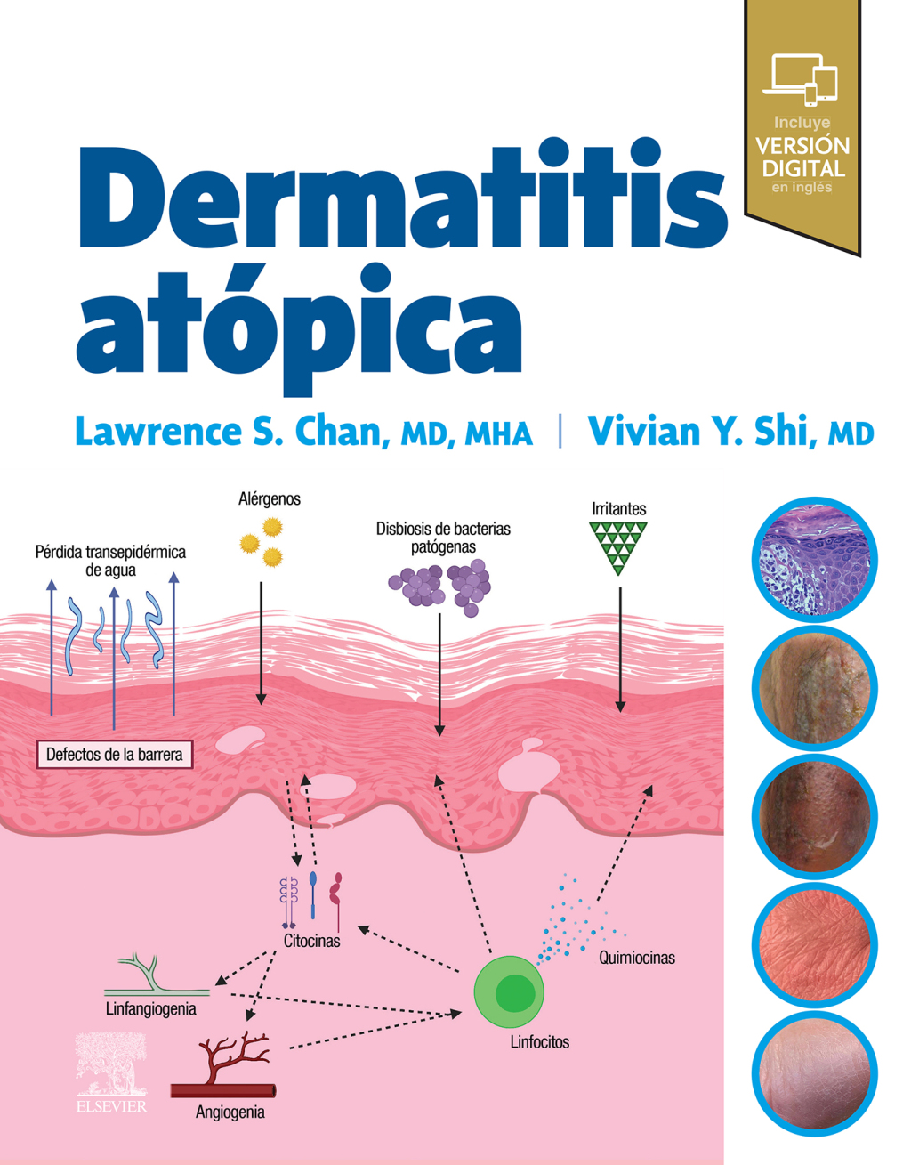 Dermatitis atópica (Original PDF from Publisher)