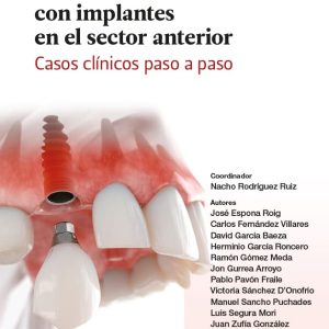 Tratamientos restauradores con implantes en el sector anterior. Casos clínicos paso a paso. (EPUB)