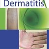 Atopic Dermatitis (Original PDF from Publisher)