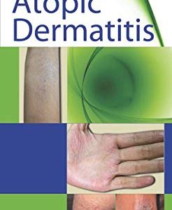Atopic Dermatitis (Original PDF from Publisher)