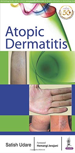 Atopic Dermatitis (Original PDF from Publisher)