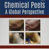 Chemical Peels: A Global Perspective (Original PDF from Publisher)
