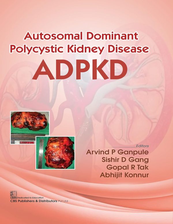 Autosomal Dominant Polytechnic Kidney Disease ADPKD (Original PDF from Publisher)