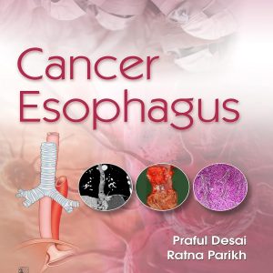 Cancer Esophagus (Original PDF from Publisher)