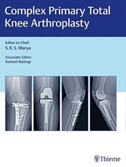Complex Primary Total Knee Arthroplasty (Original PDF from Publisher)