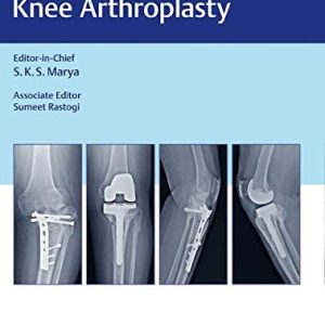 Complex Primary Total Knee Arthroplasty (Original PDF from Publisher)