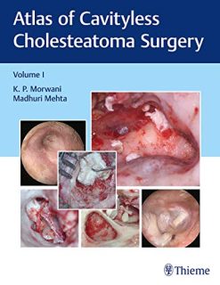 Atlas of Cavityless Cholesteatoma Surgery (Volume 1) (Original PDF from Publisher)