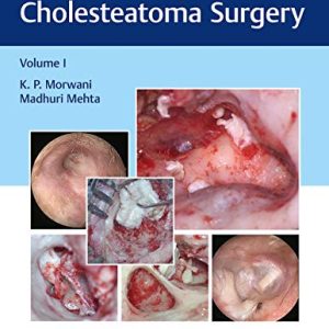 Atlas of Cavityless Cholesteatoma Surgery (Volume 1) (Original PDF from Publisher)