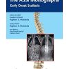 The ASSI Monographs: Early Onset Scoliosis (Original PDF from Publisher)