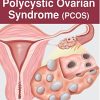 Decoding Polycystic Ovarian Syndrome (PCOS) (Original PDF from Publisher)