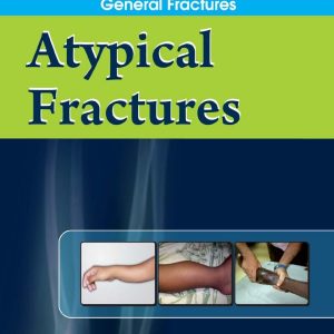 Atypical Fractures (EPUB)