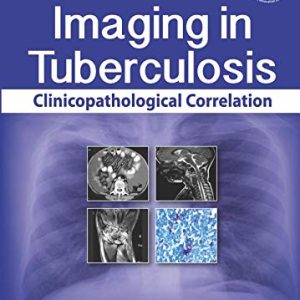 Imaging in Tuberculosis: Clinicopathological Correlation (Original PDF from Publisher)