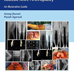 Computer Navigated and Handheld Robotic Knee Arthroplasty: An Illustrative Guide (Original PDF from Publisher)