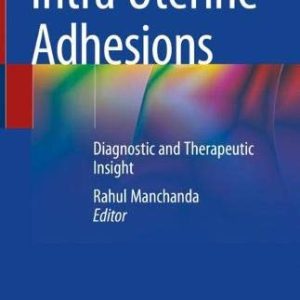 Intra Uterine Adhesions: Diagnostic and Therapeutic Insight (Original PDF from Publisher)