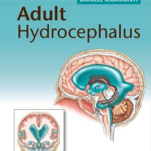 Adult Hydrocephalus (Cambridge Medicine)