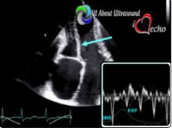 Mastering Constrictive Pericarditis – AllAboutUltrasound 2022 (Complete HTML)