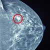 UCSF Breast Imaging 2022 (Videos)
