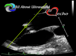 Mastering Aortic Stenosis – AllAboutUltrasound 2022 (Complete HTML)