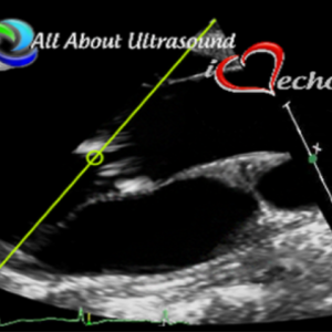 Mastering Aortic Stenosis – AllAboutUltrasound 2022 (Complete HTML)