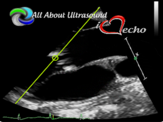 Mastering Aortic Stenosis – AllAboutUltrasound 2022 (Complete HTML)