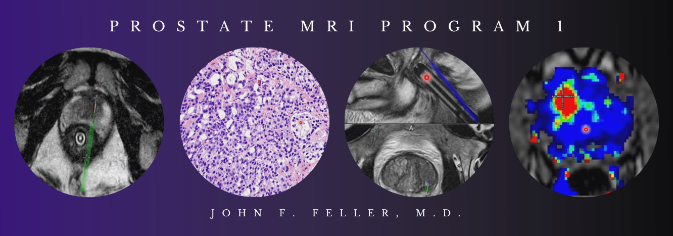 2021 Prostate MRI (Program 1) – John F. Feller, M.D (Videos)