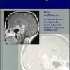 Chordomas and Chondrosarcomas of the Skull Base and Spine 1st Edition Edition (Original PDF from Publisher)