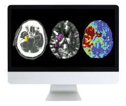 ARRS Code Stroke: What Every Radiologist Should Know 2022 (Videos)
