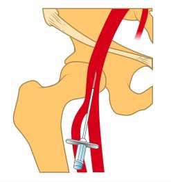 MRIOnline Imaging Mastery Series: Arterial Access – Principles, Pearls, Pitfalls, and Complications 2021 (Videos)