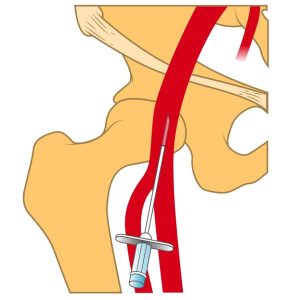 MRIOnline Imaging Mastery Series: Arterial Access – Principles, Pearls, Pitfalls, and Complications 2021 (Videos)