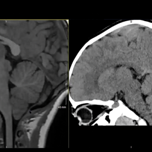 MRIOnline MRI Mastery Series: Infratentorial/Posterior Fossa Defects 2021 (Videos)