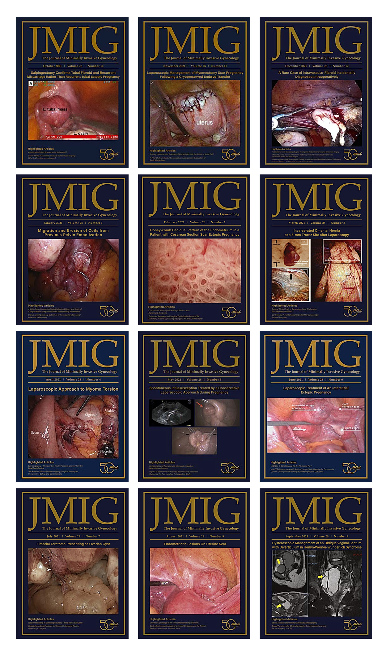 Journal of Minimally Invasive Gynecology 2021 Full Archives (True PDF)