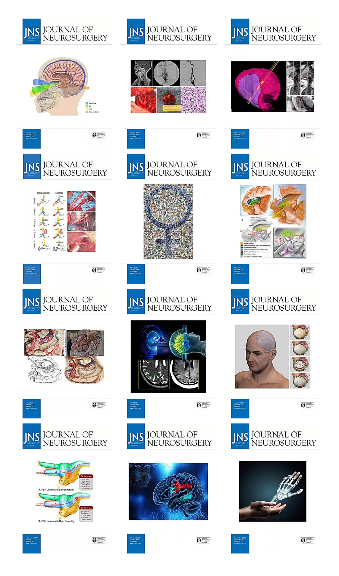 Journal of Neurosurgery 2023 Full Archives (True PDF)