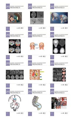 Journal of Neurosurgery: Pediatrics 2022 Full Archives (True PDF)
