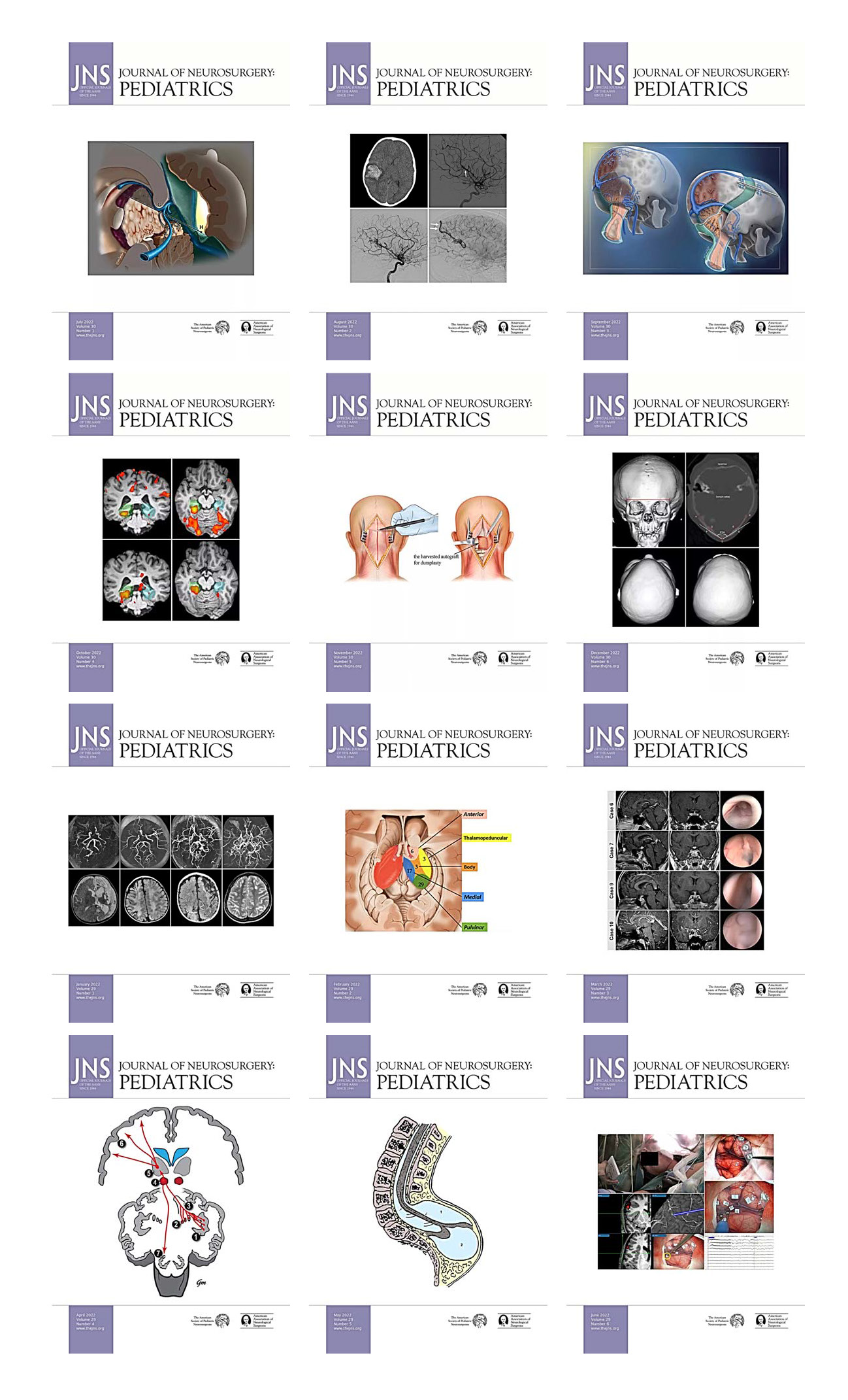 Journal of Neurosurgery: Pediatrics 2022 Full Archives (True PDF)