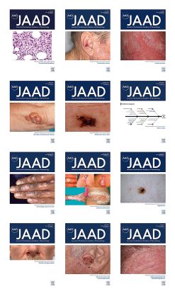 Journal of the American Academy of Dermatology 2023 Full Archives (True PDF)