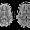 MRIOnline Imaging Mastery Series: Neurocutaneous Syndromes 2021 (Videos)