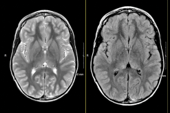 MRIOnline Imaging Mastery Series: Neurocutaneous Syndromes 2021 (Videos)