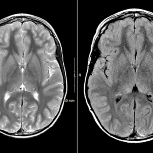 MRIOnline Imaging Mastery Series: Neurocutaneous Syndromes 2021 (Videos)