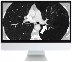ARRS Basic Chest Imaging 2019 (Videos)